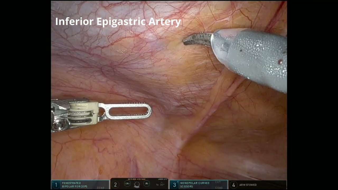 25 123 Maximizing Minimally Invasive Techniques A Multidisciplinary Robotic Deep Inferior Epigast...