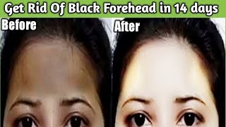 How to remove darkness from forehead in hindi/Get rid of Black forehead