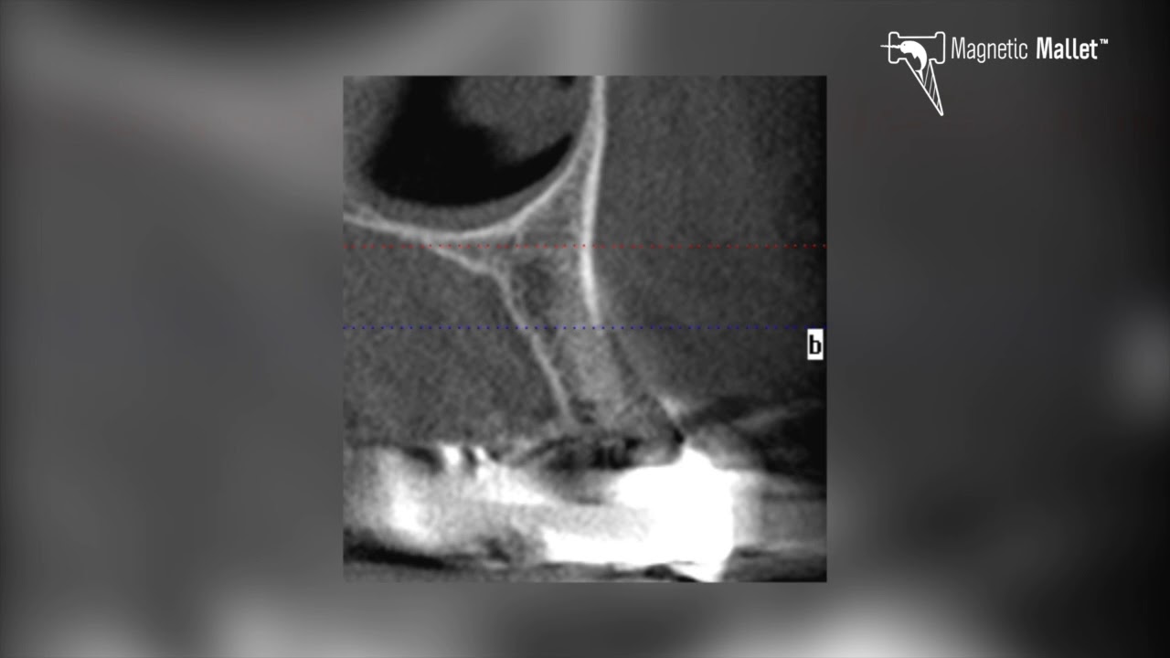 extraction and immediate implant placement with Mallet YouTube
