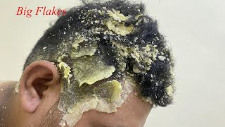 DRY SCALP !! Big Flakes Dandruff Scratching Satisfying Video #769