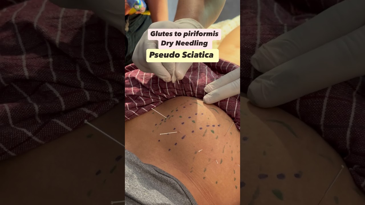 Sciatica pain Treatment 📞9871375767 #chiropractic #chiropractor Chiropractor in Gurgaon