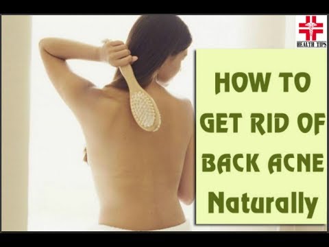 How To | Get Rid Of Back Acne | Naturally | Home Remedies | [HEALTH TIPS]