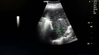 Hepatic abscess ultrasound and gas in hepatic veins