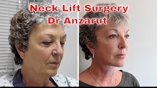 Neck lift surgery explained  everything you want to know about neck rejuvenation with Dr Anzarut