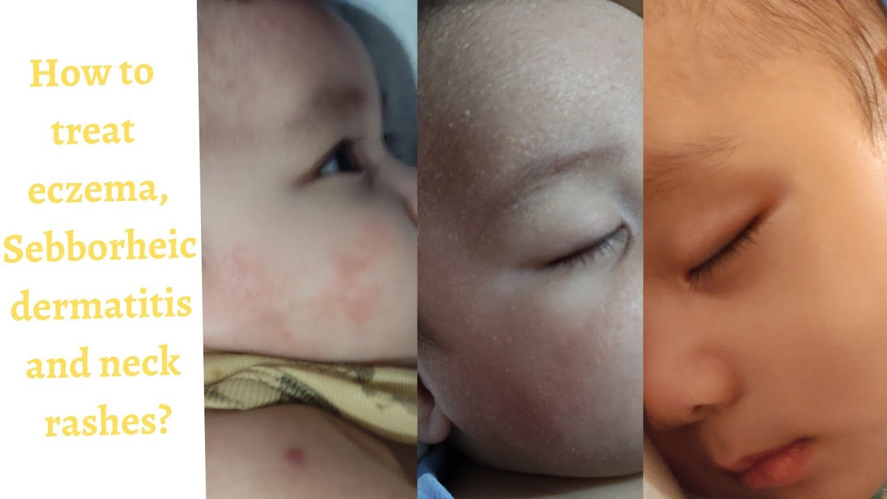 PRESCRIBED EFFECTIVE PRODUCTS FOR BABY NECK RASH, SEBBORHEIC DERMATITIS
