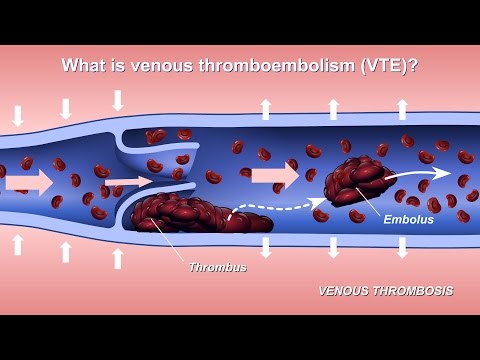 درک و تشخیص ترومبوآمبولی وریدی (VTE)