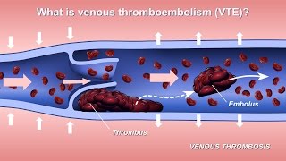 Understanding and Diagnosing Venous Thromboembolism (VTE)