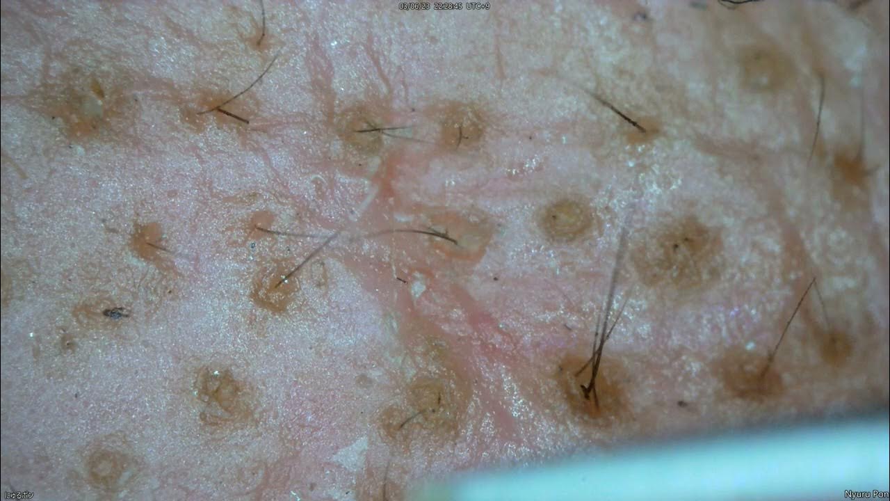 0165 keratin plug removal nose YouTube