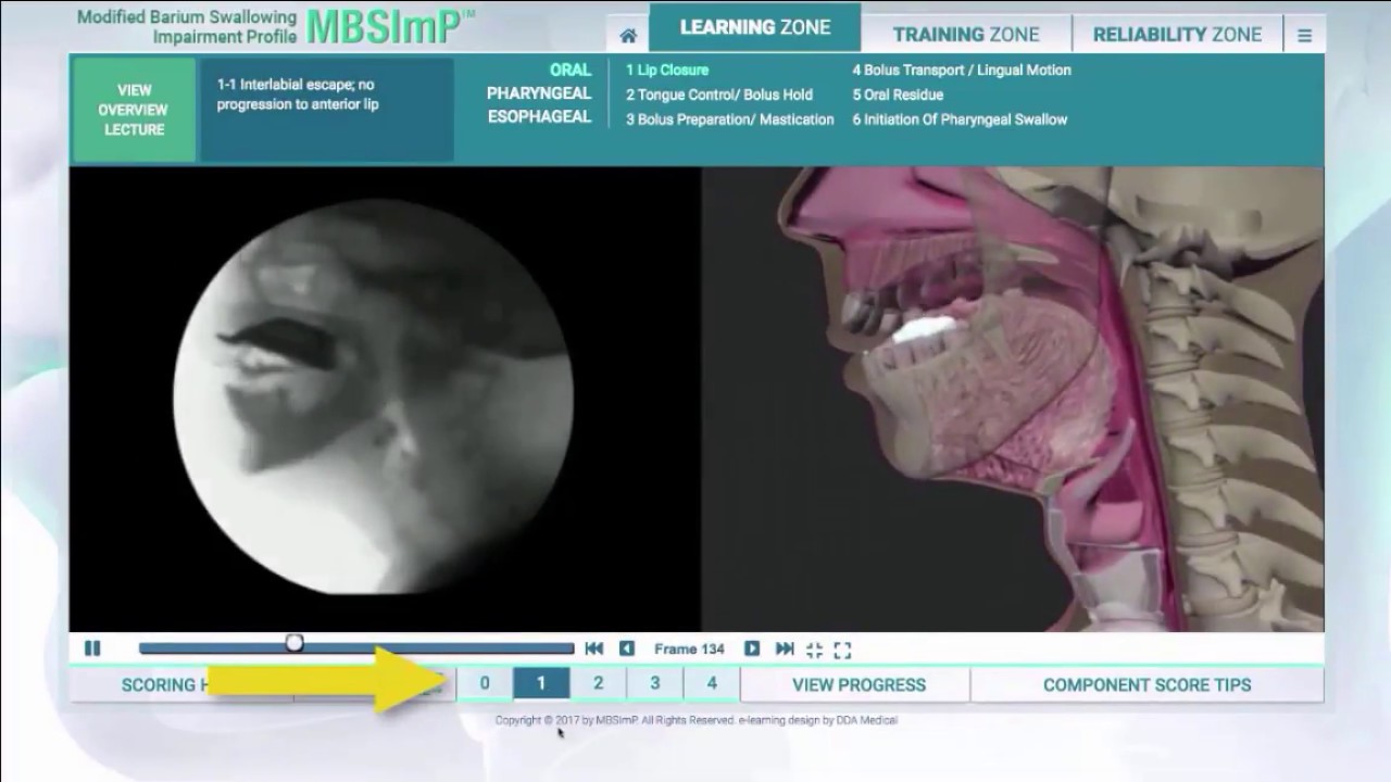 MBSImP | Modified Barium Swallow Impairment Profile