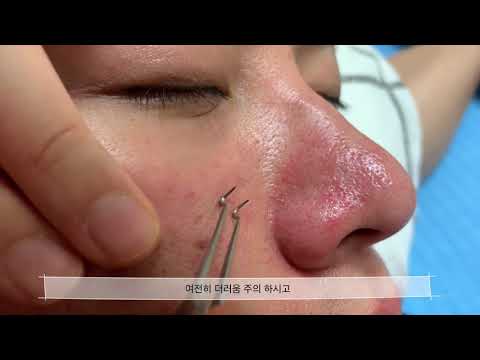 여드름피부과 추천