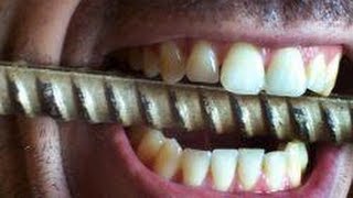 Bruxism. WORST Teeth Grinding! Like Nails On Chalkboard. Bruxism. WORST Teeth Grinding! Like Nails On Chalkboard.