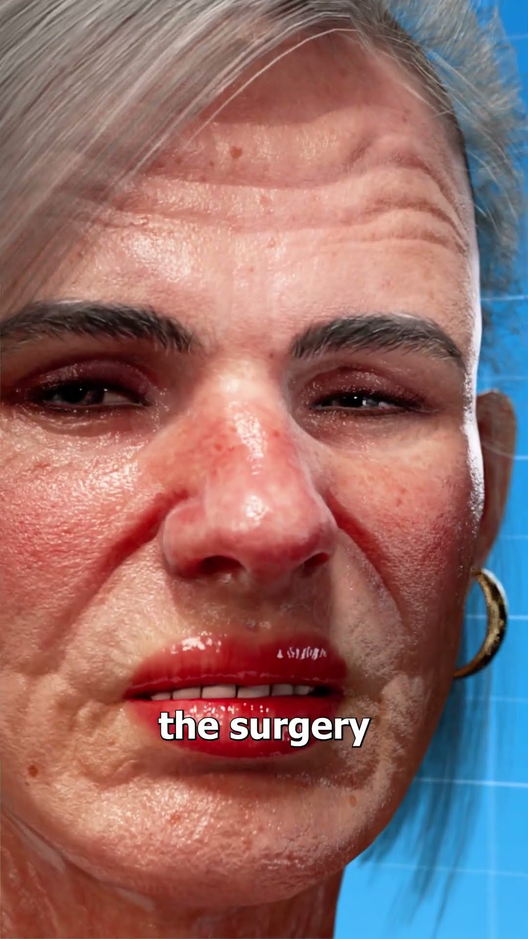 Bones Grew In Her Eye ?
