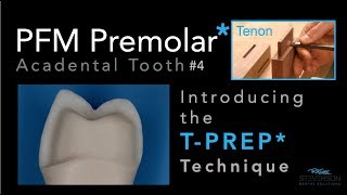 PFM Premolar Using T-PREP Technique - Acadental Tooth #4