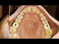 #screw retained dental implants #dental implants #dentalcrownsbeforeafter #dentalcrowns #thedentalv
