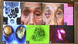 AIOC2026 IC19 Parasitic Diseases of Orbit and Adnexa case Based Dr Yashdeep Das