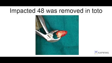 Auto transplantation of wisdom tooth