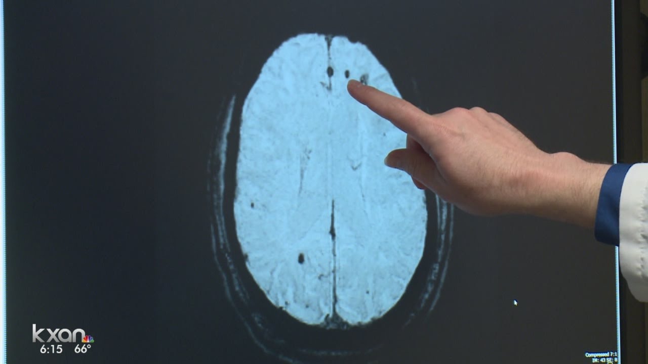 A new Mayo Clinic study that finds disturbing numbers of CTE damage in ...