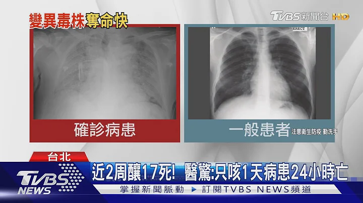 近2周酿17死! 医:病患肺"全白浸润"只咳1天 24小时亡｜TVBS新闻 - 天天要闻