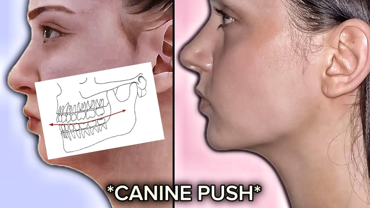 Canine Push Technique for Forward Growth