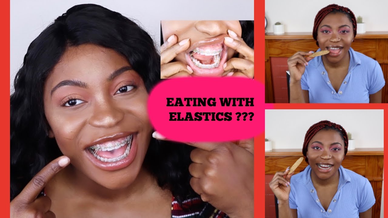 Can You Eat Food With Elastics On Your Braces Youtube 