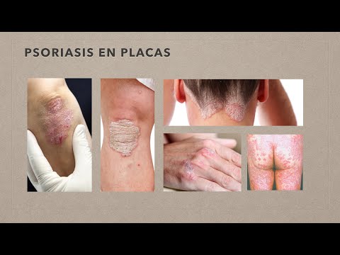 Vídeo: Psoriasis: ¿Cuál Es El Enlace Genético?