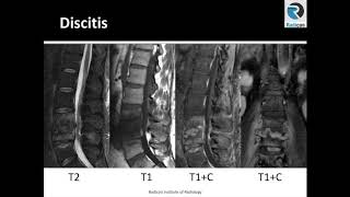 Lumbar Spine MRI Part 12: Discitis