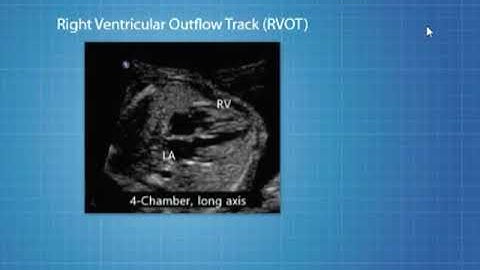Step 7: The Fetal Cardiac Echo: The Right Ventricular Outflow Tract (RVOT)