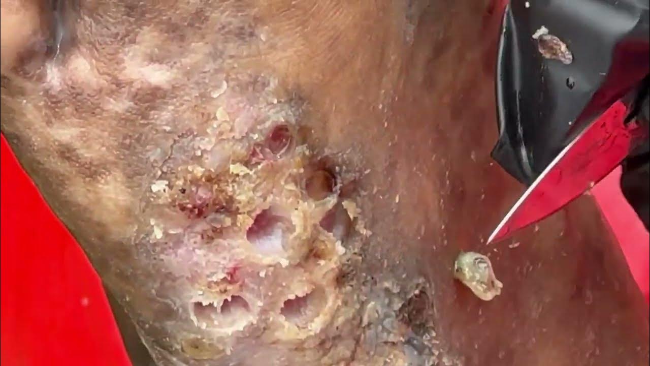 Mwajuma's feet jigger dug SO MANY BIG JIGGERS REMOVED YouTube