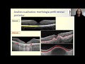 OCT Estructural en Retina / OCT-A en el Consultorio