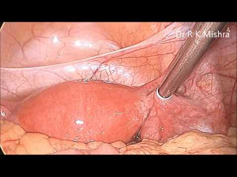 Postpartum Tubal Sterilization Overview Technique Periprocedural Care