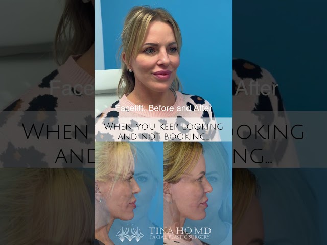 Facelift before and after! #plasticsurgery #facelift #drtinaho #necklift
