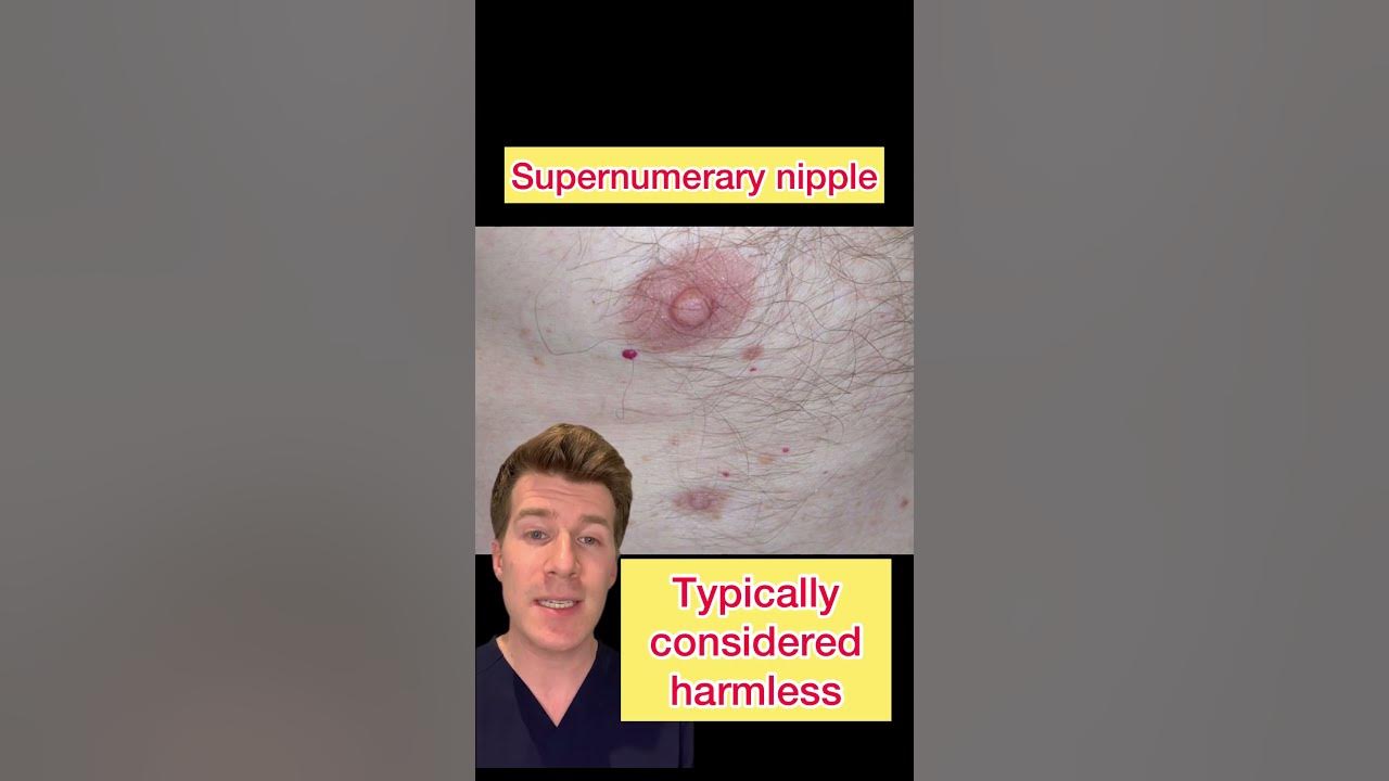 part-2-supernumerary-nipple-aka-third-nipple-explained-shorts
