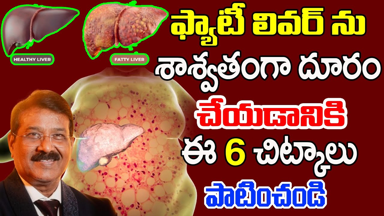 🔴Live : ఫ్యాటీ లివర్ శాశ్వతంగా దూరం చేయడాని 6 చిట్కాలు || 6 Tips Get Rid Of Fatty Liver Permanently