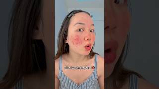 Anyone else experience this? ๐ฅฒ๐ซ #acne #skincare #clearskin #relatable Anyone else experience this? ๐ฅฒ๐ซ #acne #skincare #clearskin #relatable