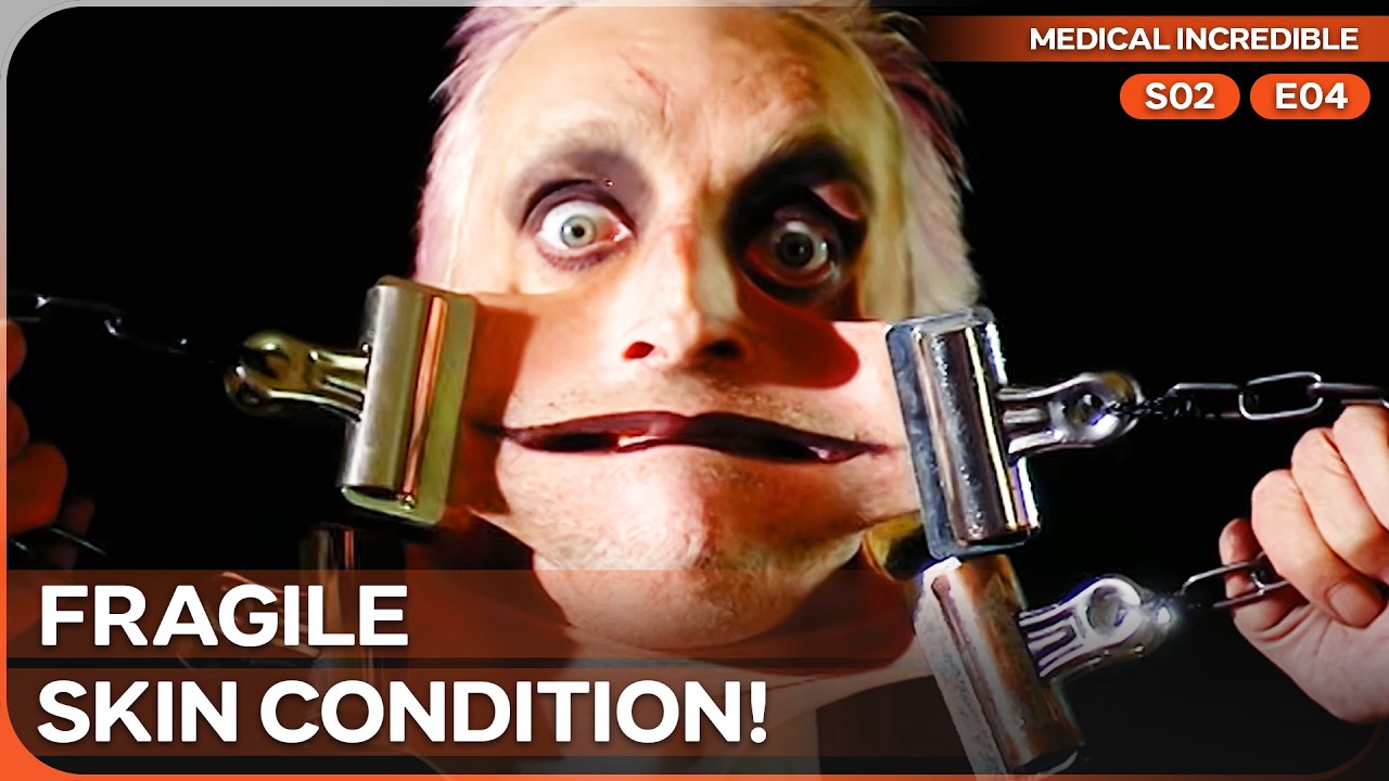 The Man With the World's Stretchiest Skin