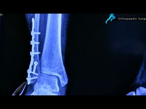 Ankle Fracture : Dr Ashwani Maichand