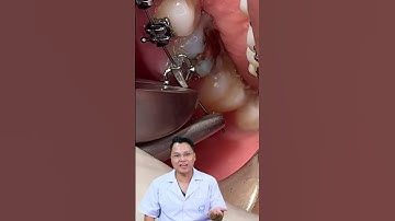 Cắt dây thừa Bác sĩ Cường | Dr Cường Offical #drcuong #shorts