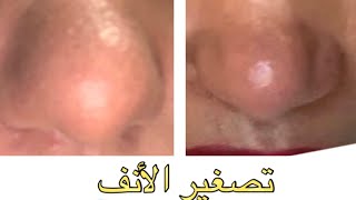 #plasmapen #fibroblast #plaxel+ تصغير الأنف بدون عملية جراحية