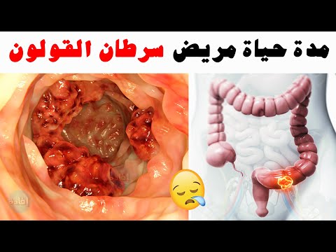 مدة حياة مريض سرطان القولون