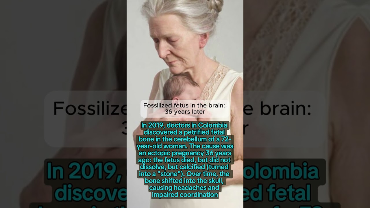 Fossilized fetus in the brain: 36 years later