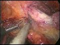 Laparoscopic radical hysterectomy for carcinoma cervix