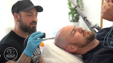 Scalp Micro Pigmentation (SMP) Laser Removal #smp #smprepair  #smpremoval #scalpmicropigmentation