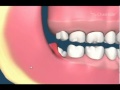 Impacted Wisdom Teeth Removal Animation)