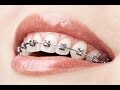 Foods to Eat and Avoid with Braces
