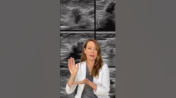What Does Breast Cancer Look Like on an Ultrasound?