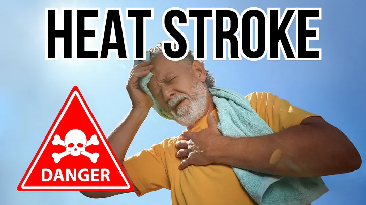 Doctor explains Heatstroke (Sun Stroke) | Causes, Symptoms, Treatment
