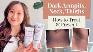 Treating And Preventing Dark Armpits Thighs Neck And Arms Dr Jenny Liu