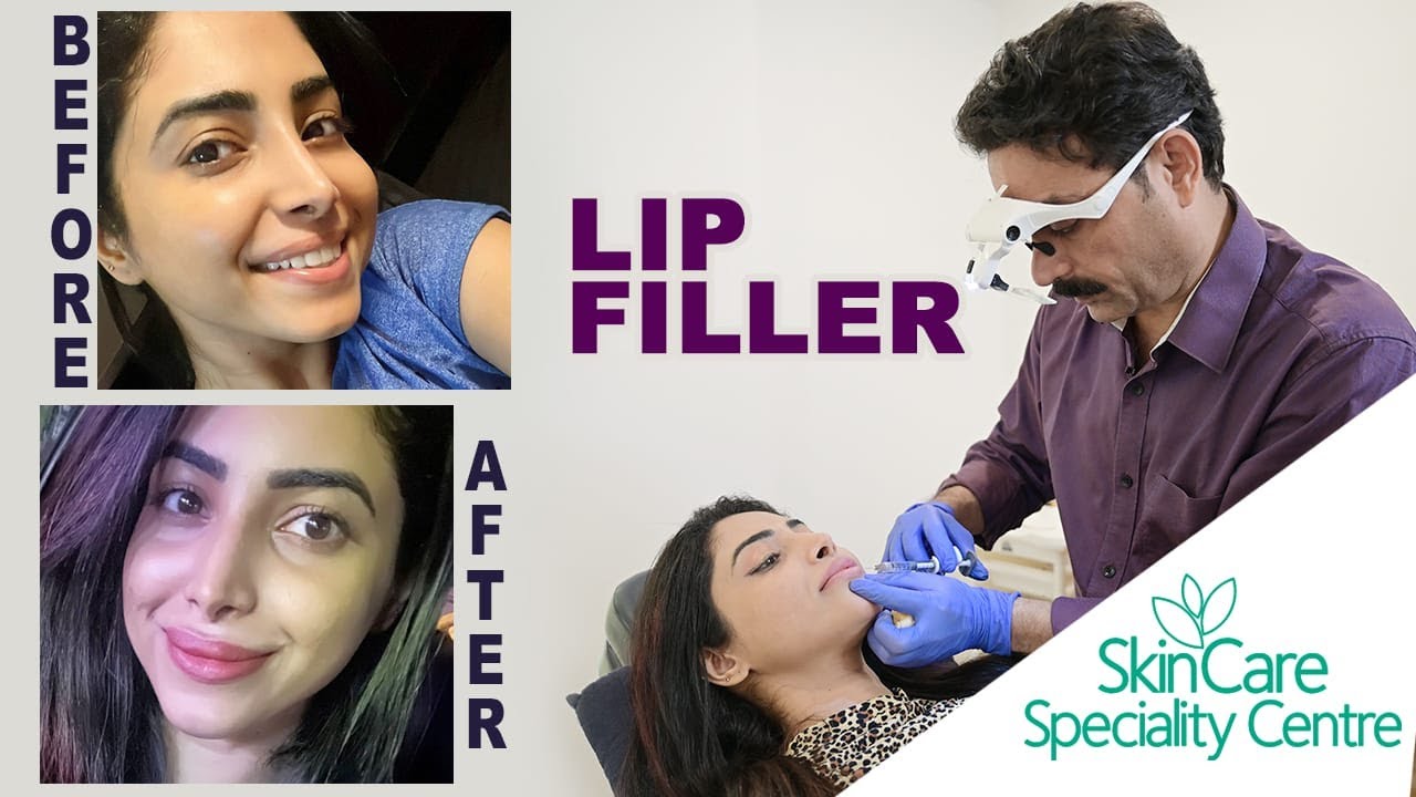 Lip fillers before and after in malayalam YouTube