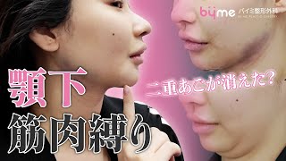 【衝撃ビフォーアフター】顎下スッキリで激変！BYMEペリカン手術のリアル手術映像