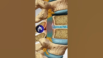 Lumbar Intervertebral Disc Herniation - 4K 3D Animation